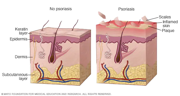 Gambar penyakit kulit psoriasis dan perbedaannya dengan kulit normal.