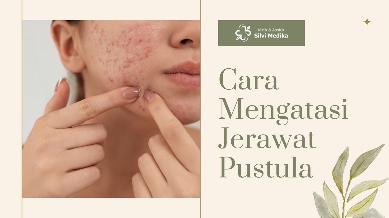 Cara Mengatasi Jerawat Pustula