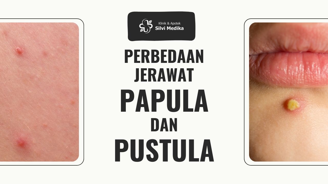 perbedaan jerawat papula dan pustula